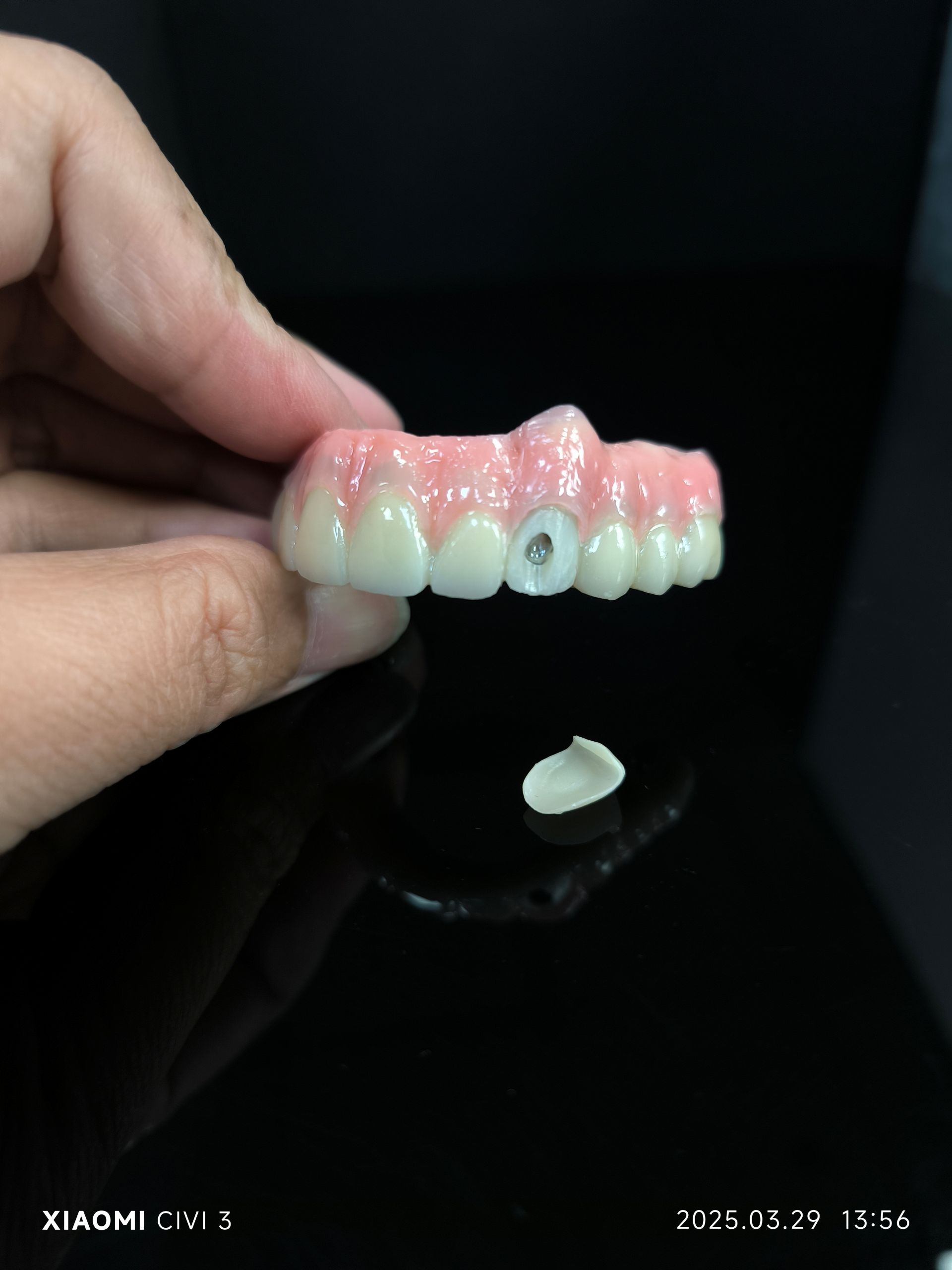 Go léir ar 4 hibrid - tuaslagán droichid zirconia hibrideach do pholl scriú vestibular