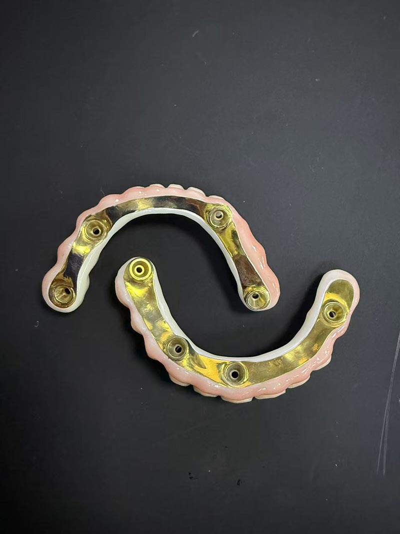 Buntáistí agus Míbhuntáistí a bhaineann le Barra-Gearrthóg Implant-Tacaithe Overdenture