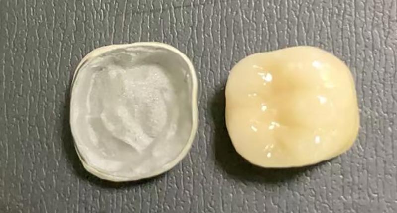 Cad atá le déanamh Nuair a bheidh Do Sceallóga Corónach poircealláin? Seo an Fáth a Tharlaíonn sé & Conas É a Dheisigh