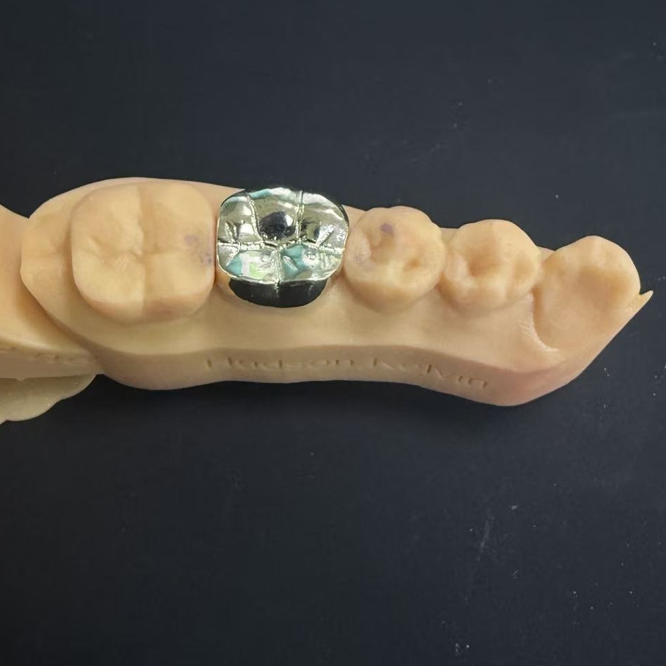 Corónacha Óir: An Rogha Miotail lómhara le haghaidh Athchóiriú Fiaclóireachta ar feadh an tSaoil