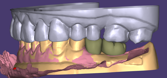 Buann Céir Aeistéitiúil agus Athchóirithe Sealadacha WM Dental Lab Moladh d’aon toil ó Chustaiméirí