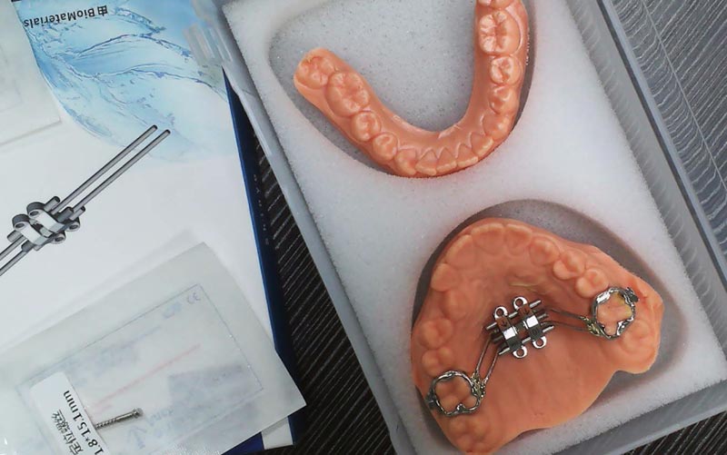 Síneadh Cnámharlaigh MSE le WM Dental Lab a thuiscint