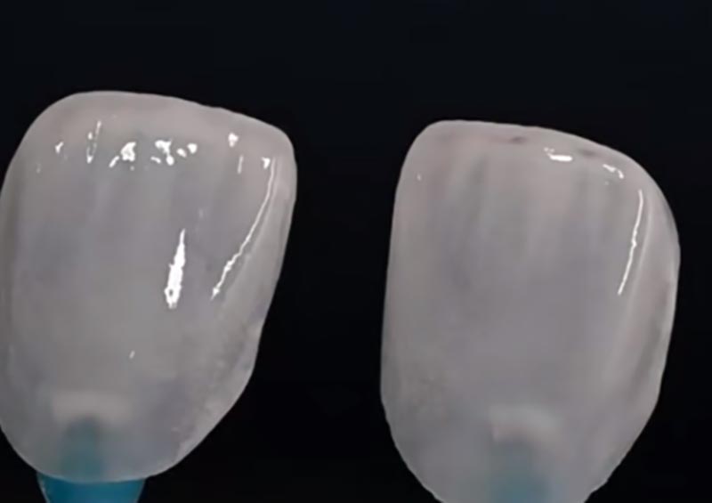 Veneers vs Crowns: Conas an Athchóiriú Ceart a Roghnú le haghaidh na dTorthaí Aeistéitiúla agus Feidhmiúla is Fearr