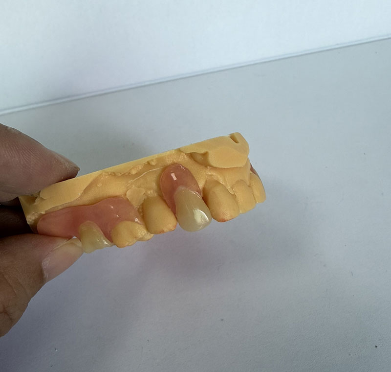 Páirteanna Valplast ag WM Dental Lab