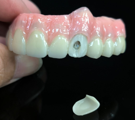 Go léir ar 4 hibrid - tuaslagán droichid zirconia hibrideach do pholl scriú vestibular