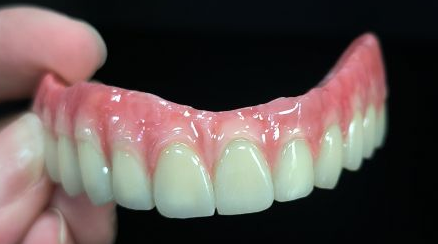 Go léir ar 4 hibrid - droichead malo corónacha zirconia iomlán thar struchtúr tíotáiniam