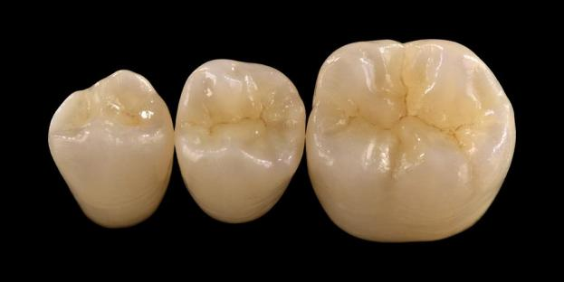 <h2>Zirconia i bhFiaclóireacht: Tásca, Buntáistí, agus Cúrsaí Cliniciúla</h2>
<p>Aithnítear Zirconia go forleathan as a neart agus a marthanacht. Tairgeann na glúnta is déanaí d'ábhair zirconia airíonna aeistéitiúla feabhsaithe go suntasach freisin. I gcás othair atá ag smaoineamh ar athchóirithe uile-cheirmeacha, tá sé riachtanach táscairí agus teorainneacha na gcóras zirconia-bhunaithe a mheas go cúramach.</p>
<p>Tá othair an lae inniu ag súil níos mó agus níos mó le hathchóirithe a chomhcheanglaíonn aeistéitic den scoth le feidhmíocht fheidhmiúil iomlán. Is féidir leis an gcuid is mó de na córais ceirmeacha nua-aimseartha na hionchais seo a chomhlíonadh, ach braitheann rath cliniciúil den chuid is mó ar roghnú ábhar cuí, ullmhú fiacail, agus prótacail stroighne. Ba cheart go mbeadh an rogha á threorú ag príomh-airíonna ábhartha cosúil le friotaíocht briste, neart flexural, friotaíocht caitheamh, agus cobhsaíocht fhadtéarmach. I measc na n-ábhar seo, tá zirconia anois ar cheann de na roghanna is mó a úsáidtear i bhfiaclóireacht aisiríoch comhaimseartha.</p>
<h3>Cén fáth Roghnaigh Zirconia?</h3>
<p>Tá luach ag Zirconia as a neart eisceachtúil agus marthanacht fadtéarmach. Tá zirconia nua-aimseartha difriúil go suntasach ó na glúnta níos luaithe, a bhí níos teimhneach agus níos lú aeistéitiúil. Sa lá atá inniu ann, cuireann teicneolaíocht CAD/CAM ar chumas athchóiriú beacht a dhéanamh ar athchóiriú zirconia le hairíonna optúla feabhsaithe.</p>
<p>Is féidir athchóirithe a dhearadh mar:</p>
<ul>
<li><strong>Siorcóine monolithic:</strong>Ideal do choróin agus droichid posterior, ag tairiscint ard-neart agus marthanacht.</li>
<li><strong>Zirconia sraitheach:</strong>Oiriúnach do chásanna a éilíonn aeistéitic feabhsaithe, lena n-áirítear athchóirithe fadréise ar fud réimsí éagsúla den bhéal.</li>
</ul>
<p>Athraíonn neart flexural ag brath ar an gcineál, ó thart ar 590 MPa i zirconia ard-tréshoilseacháin go dtí suas le 1400 MPa i bhfoirmeacha monolithic. Is féidir athchóirithe Zirconia a stroighin trí úsáid a bhaint as stroighin roisín féinghreamaitheach nó stroighin ianaiméir gloine modhnaithe.</p>
<h3>Príomhfhachtóirí i Roghnú Ábhar Zirconia</h3>
<p>Agus zirconia á bhreithniú le haghaidh athchóiriú uile-cheirmeach, ba cheart do chliniceoirí roinnt fachtóirí ríthábhachtacha a mheas:</p>
<ul>
<li>Struchtúr fiacail fágtha</li>
<li>Suíomh sa chuas béil (crios aeistéitiúil vs crios feidhme)</li>
<li>Láithreacht nósanna parafunctional cosúil le bruxism</li>
<li>Trédhearcacht fiacla nádúrtha in aice láimhe</li>
<li>Dath agus riocht an bhunstruchtúir fiacail</li>
</ul>
<p>Cuimsíonn an crios aeistéitiúil na fiacla roimhe go hiondúil, cé go bhféadfadh sé leathnú go dtí an chéad molar i roinnt othar ag brath ar líne aoibh gháire agus dinimic aghaidhe. Áirítear sa chrios feidhme go ginearálta premolars agus molars, áit a bhfuil fórsaí occlusal i bhfad níos airde.</p>
<h3>Feidhmchláir Chrios Feidhme</h3>
<p>I réigiúin posterior, ní mór fórsaí occlusal a mheas go cúramach. Is rogha iontach eile é Zirconia d'athchóirithe PFM traidisiúnta, go háirithe i gcásanna le spás aisiríoch teoranta. Ceadaíonn zirconia monolithic nua-aimseartha dearadh lán-chomhrianta anatamaíochta occlusal, lena n-áirítear cusps feidhmiúla agus iomairí imeallacha, agus ard-neart á chothabháil.</p>
<p>Léiríonn fianaise reatha go bhfuil zirconia monolithic oiriúnach go maith do choróin posterior agus droichid il-aonad mar gheall ar a fhriotaíocht den scoth le briseadh agus caitheamh. Chuir dul chun cinn i dteicnící greamaitheacha agus dearadh ullmhúcháin feabhas ar thorthaí cliniciúla fadtéarmacha freisin.</p>
<h3>Feidhmchláir Crios Aeistéitiúla</h3>
<p>Sa réigiún roimhe seo, caithfidh athchóirithe dath fiacail nádúrtha, tréshoilseacht agus iompar éadrom a mhacasamhlú go dlúth. Cé go dtugann ábhair ar nós litiam disilicate aeistéitic den scoth, níl siad chomh láidir agus is gnách go mbíonn gá le nascáil ghreamaitheacha.</p>
<p>Buntáiste lárnach de zirconia is ea a chumas a bheith cementáilte go traidisiúnta agus ardfheidhmíocht aeistéitiúil á bhaint amach fós. Le forbairt na gcóras zirconia ard-tréshoilseacha agus ilchiseal, is féidir anois athchóirithe a dhéanamh a dhéanann aithris go dlúth ar fhiaclóireacht nádúrtha.</p>
<p>Cuireann ardteicníochtaí próiseála feabhas breise ar airíonna optúla agus laghdaítear imperfections a d'fhéadfadh cur isteach ar tharchur agus ar chuma an tsolais.</p>
<h3>Neart agus Aeistéitic le chéile</h3>
<p>Thug córais luath-zirconia tosaíocht do neart ach ní raibh cáilíocht aeistéitiúil ann. Comhcheanglaíonn zirconia monolithic nua-aimseartha neart agus cuma feabhsaithe araon, rud a fhágann go bhfuil sé oiriúnach do raon leathan cásanna cliniciúla.</p>
<p>Tá sé tairbheach go háirithe d’othair a bhfuil nósanna parafunctional nó teipeanna athchóirithe roimhe seo acu. Léiríonn staidéir chliniciúla glacadh ard othar agus rátaí ísle casta.</p>
<p>Laghdaíodh imní maidir le caitheamh ar fhiacla codarsnachta le foirmlithe níos nuaí. Léiríonn dromchlaí zirconia an-snasta acmhainneacht íseal scríobach, agus i gcásanna áirithe d'fhéadfadh siad a bheith níos uaisle ná athchóirithe traidisiúnta poircealláin-chomhleáite-go-miotail.</p>
<h3>Implants Zirconia: Malartach ag Teacht Chun Cinn</h3>
<p>Cé go bhfanann ionchlannáin tíotáiniam mar an gcaighdeán cliniciúil, tá aird á tabhairt ar ionchlannáin zirconia mar rogha eile saor ó mhiotail. Córais aonphíosa a bhí i ndearaí luatha go príomha, ach ceadaíonn ionchlannáin zirconia dhá phíosa solúbthacht próstéiseach feabhsaithe anois.</p>
<p>Tá ionchlannáin Zirconia an-úsáideach i gcásanna ina bhfuil imní aeistéitiúil ann, amhail dídhathú liath a d’fhéadfadh a bheith ann ar fhíocháin pheirea-ionchlannáin nó bithitíopa gingival tanaí. Féadfar iad a mheas freisin d’othair a bhfuil íogaireacht tíotáiniam annamh orthu.</p>
<p>Mar sin féin, tá ionchlannáin zirconia fós sách nua, agus tá sonraí cliniciúla fadtéarmacha fós teoranta i gcomparáid le córais tíotáiniam.</p>
<h3>Conclúid</h3>
<p>Tá Zirconia tagtha chun cinn ina ábhar an-versatile i bhfiaclóireacht aisiríoch, ag tairiscint cothromaíocht láidir idir feidhmíocht mheicniúil agus aeistéitic. Tá sé ríthábhachtach cásanna a roghnú go cuí agus cloí le prótacail chliniciúla chun na torthaí is fearr a bhaint amach in iarratais roimhe seo agus níos déanaí.</p>